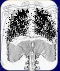 Lungs black from smoking